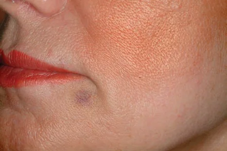 Fig 1. Hematoma leve perioral tras infiltración de labio